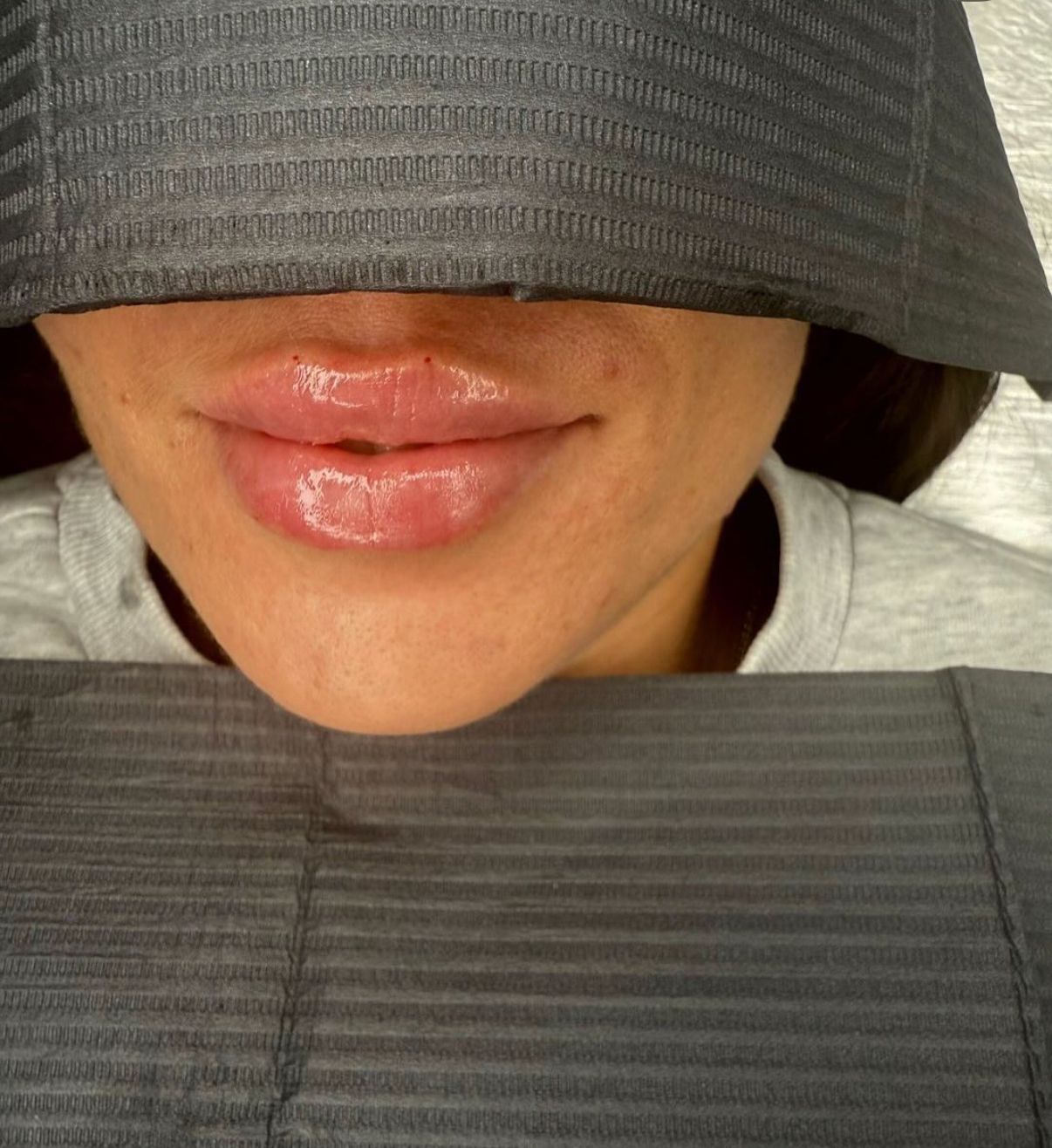 lip filler result