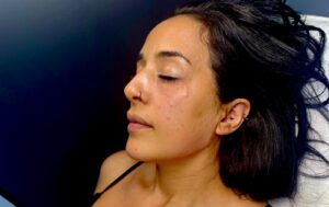 Anti-Wrinkle Consultation