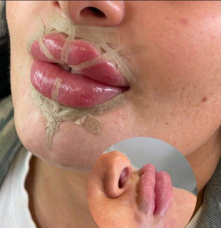 lips before and after