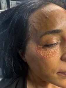 Anti-Sweating Treatment